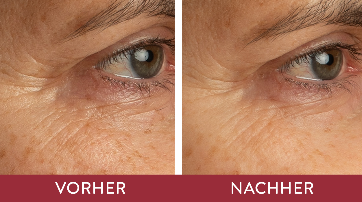 Vorher-Nachher-Effekt der Retinol Science 24H Eye Cream von Judith Williams Cosmetics, gezeigt an einem Teilausschnitt des Gesichts.