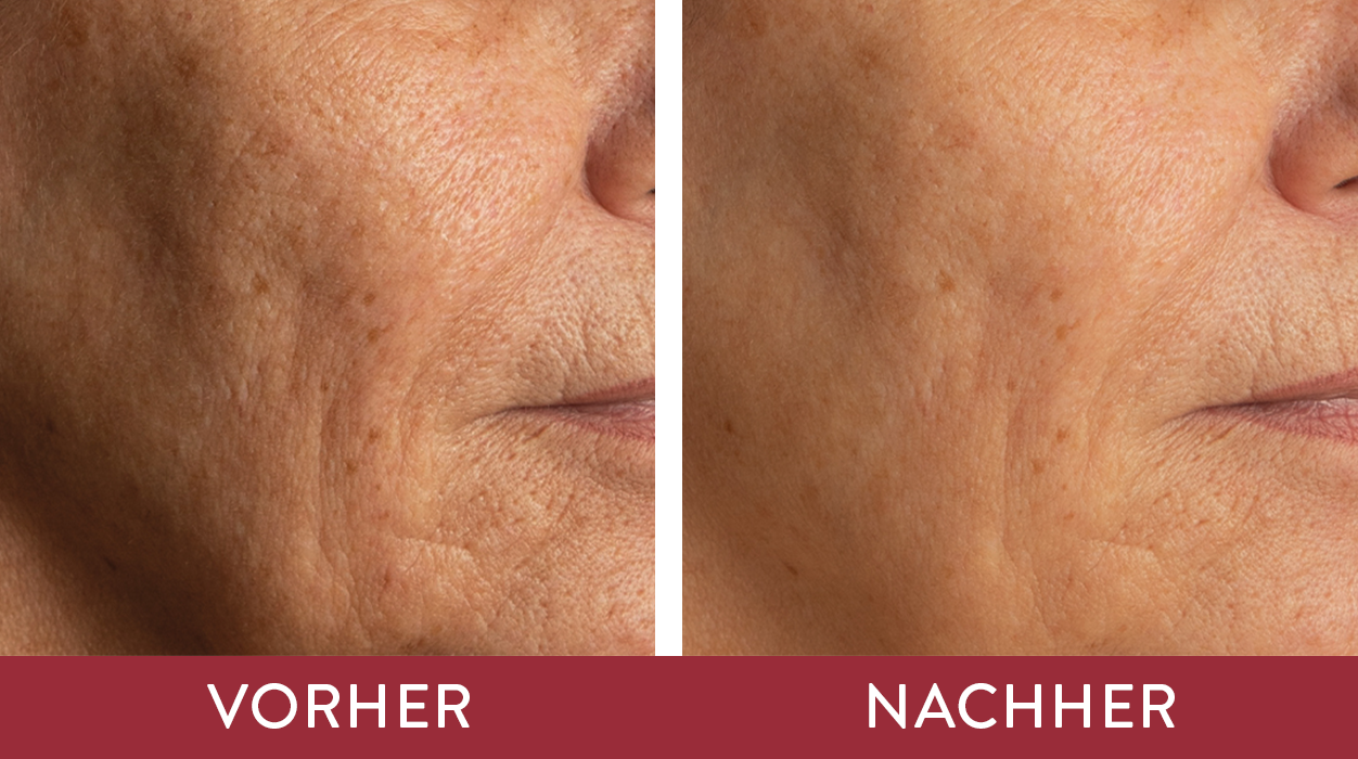Vorher-Nachher-Effekt vom Retinol Science Intense Concentrate von Judith Williams Cosmetics, gezeigt an einem Teilausschnitt des Gesichts.