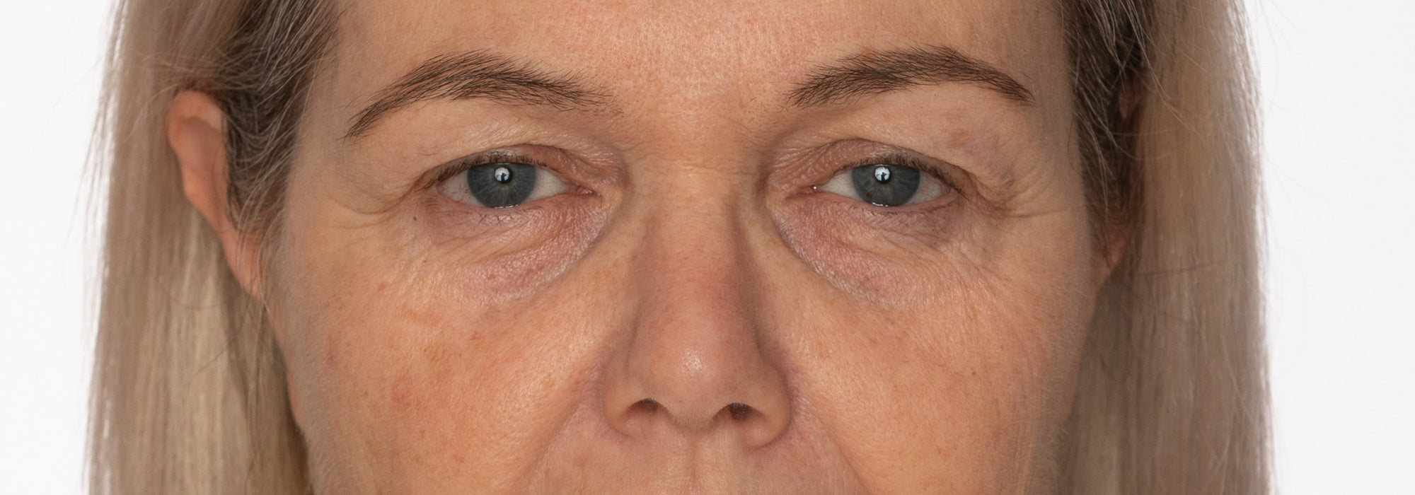 Augenpartie vor dem Auftragen der Hydrogel Eye Pads