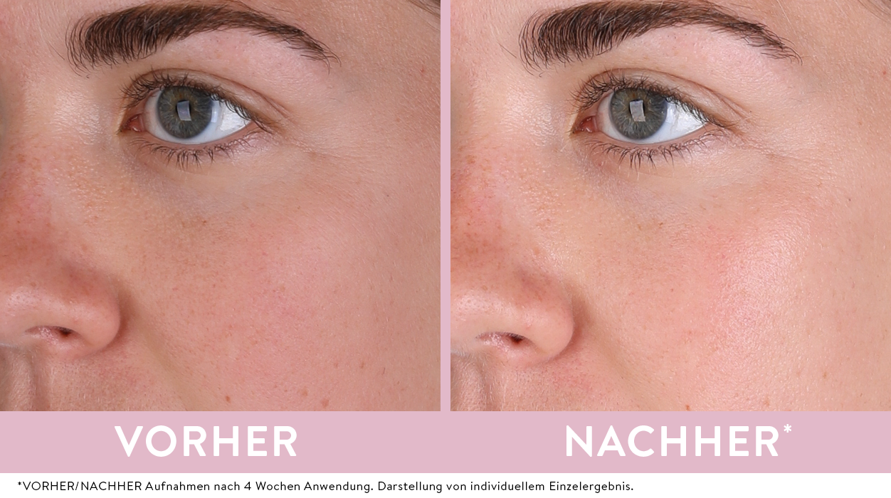 Vorher-Nachher-Effekt der Rose Tagescreme von Judith Williams Cosmetics, gezeigt an einem Teilausschnitt des Gesichts.